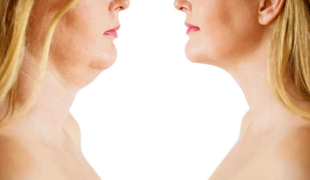 Double Chin treatment Barnet before and after results