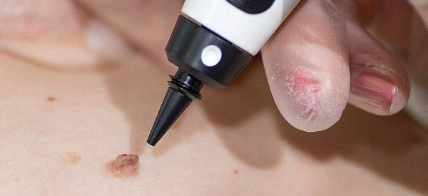 After Skin Tag Removal Barnet
