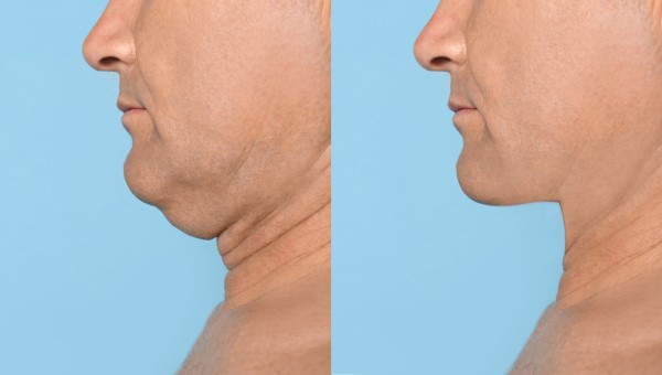 Which Non-Surgical Treatments Work Best for Jowls and Loose Skin Barnet?