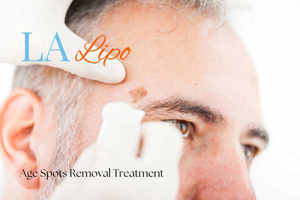 What Are the Most Effective Treatments for Age Spots Barnet?