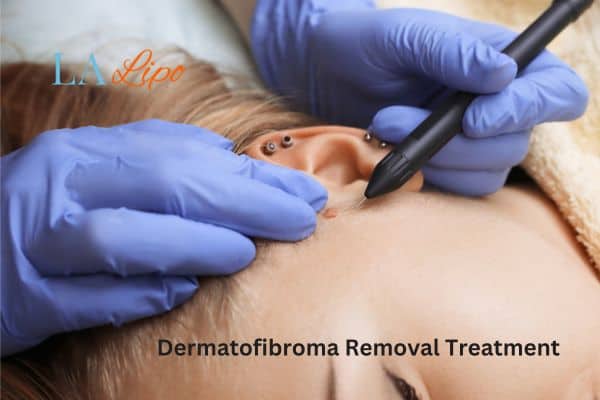 Dermatofibroma Removal Treatment Barnet