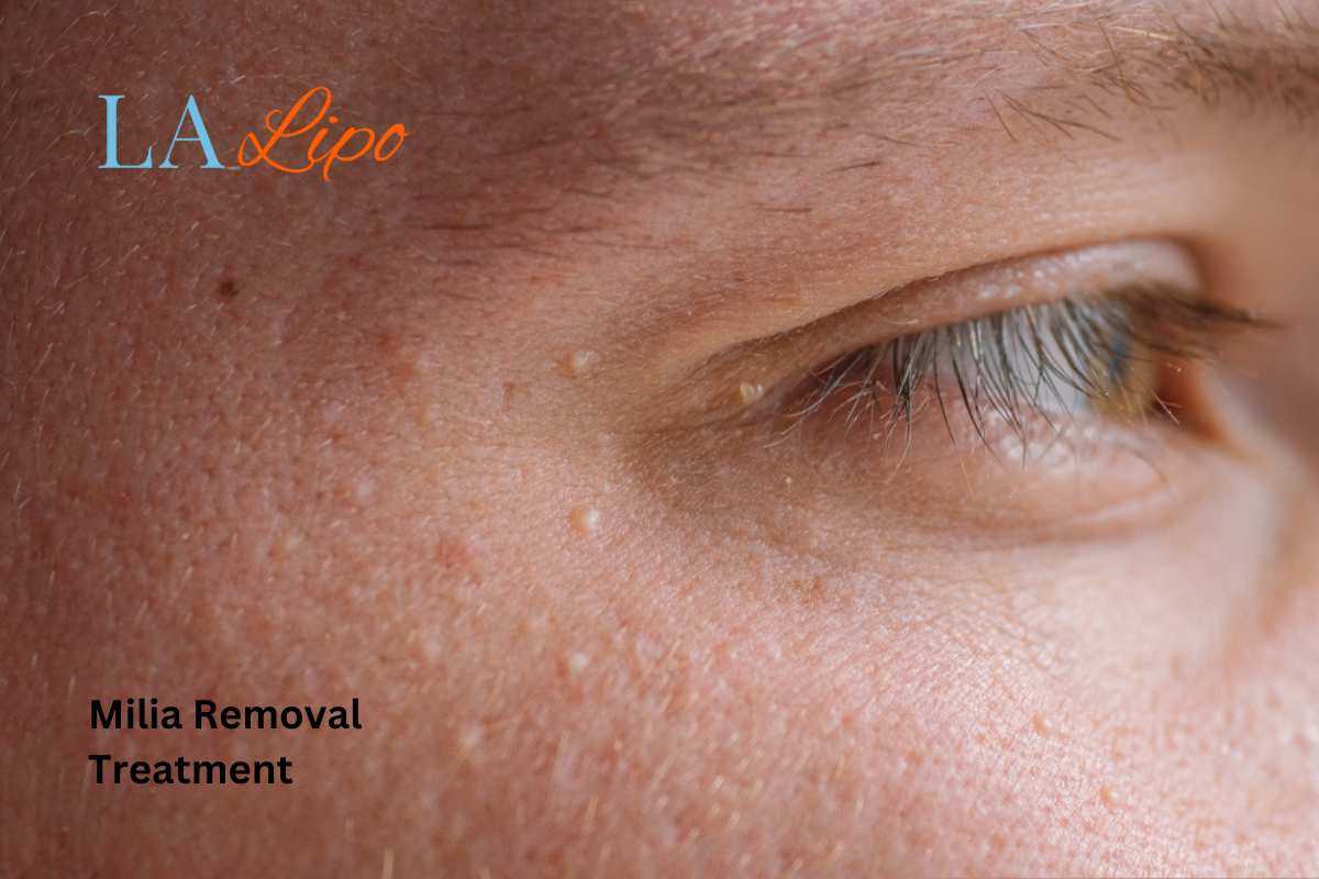 Cryopen Milia Removal: Is It the Easiest and Safest Option Barnet?