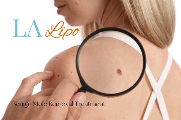 Woman having her inspection of blemish before mole removal Barnet