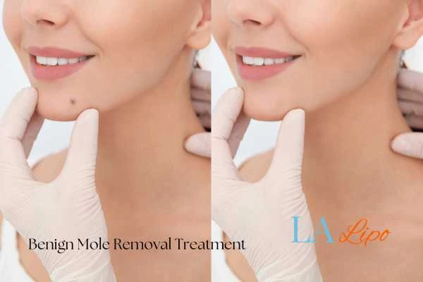 woman's before and after mole removal Barnet results