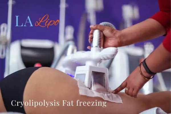 women getting fat freezing Barnet