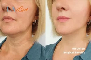 hi-fu for wrinkles Barnet before and after results
