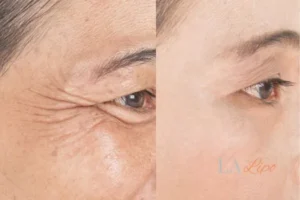 Before and after results of woman - HI-fu wrinkles reduction treatment Barnet