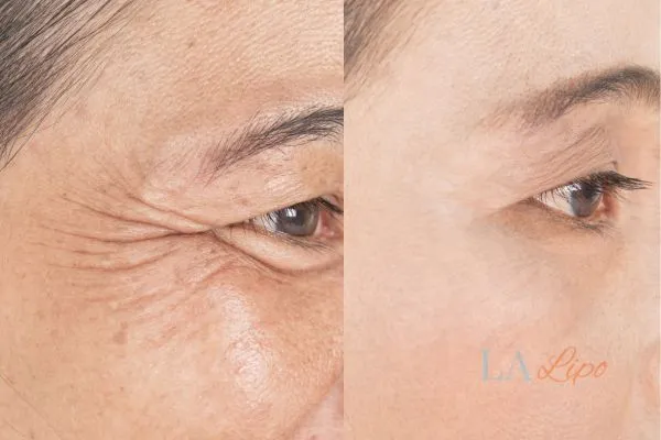 Before and after results of woman - HI-fu wrinkles reduction treatment Barnet