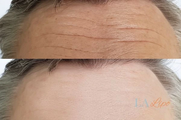results of HIFU Barnet on mans forehead to help reduce lines and wrinkles