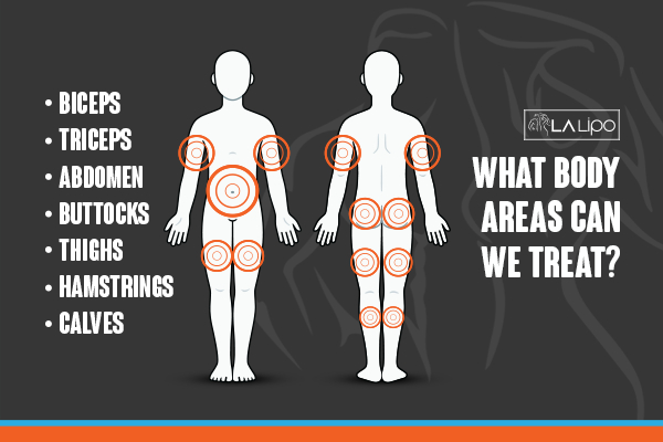 Graphic to show areas you can have LA-EMS Body Sculpting Barnet treatment.
