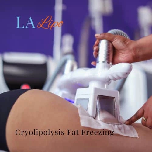 fat freezing - Cryolipolysis Barnet