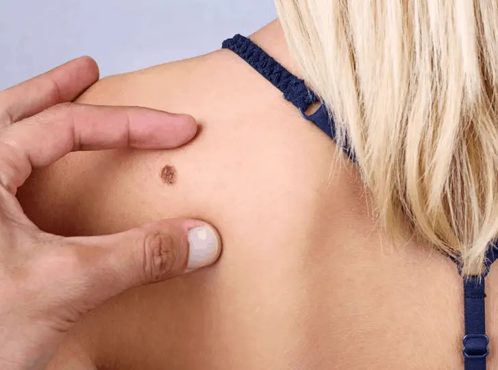 woman having mole removal Barnet consultation before treatment.