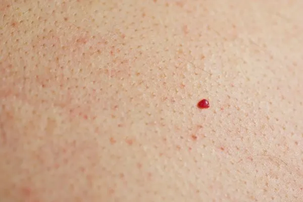close up of a cherry angioma Barnet