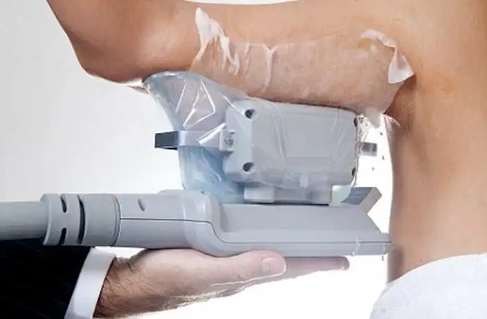 Picture of fat freezing Barnet on the upper arms.