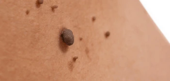 image of a skin tag Barnet