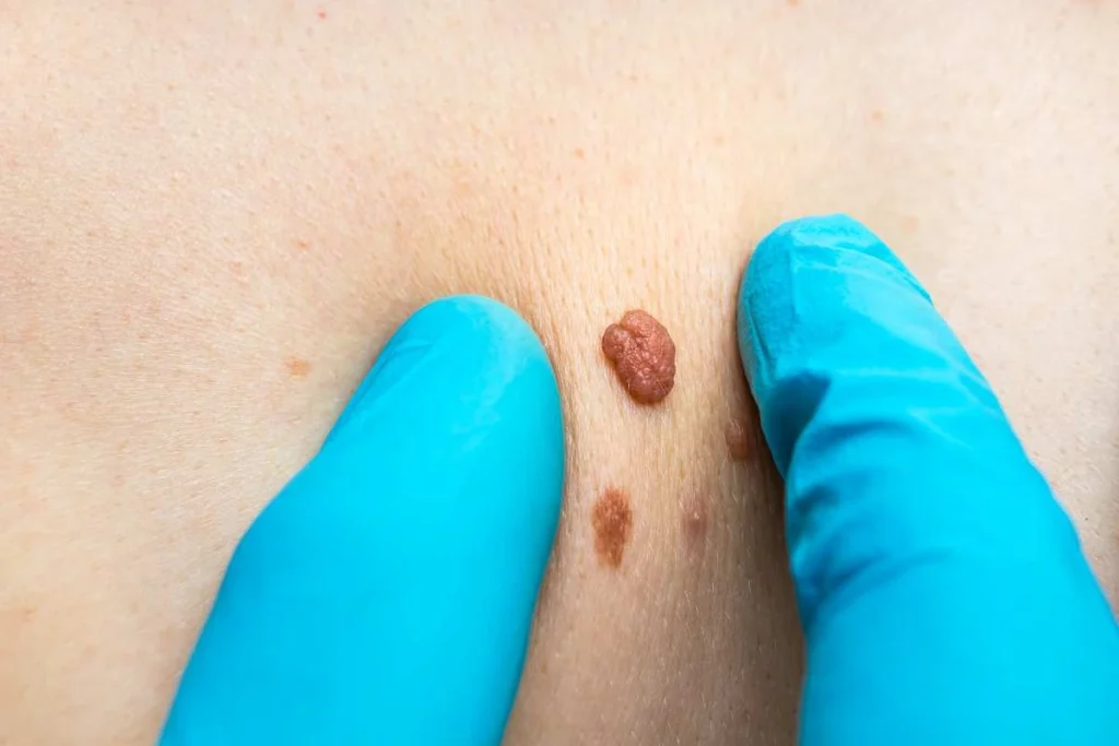 Consultant examining a skin tag Barnet