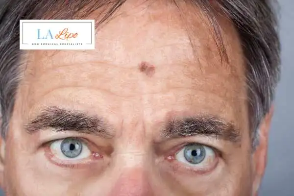Solar Lentigo Removal Barnet image of man with mark on his forehead