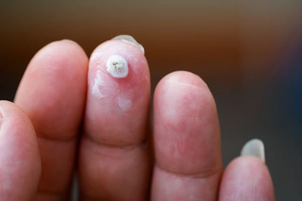 wart on person finger - cryotherapy to treat from LA LIPO Barnet