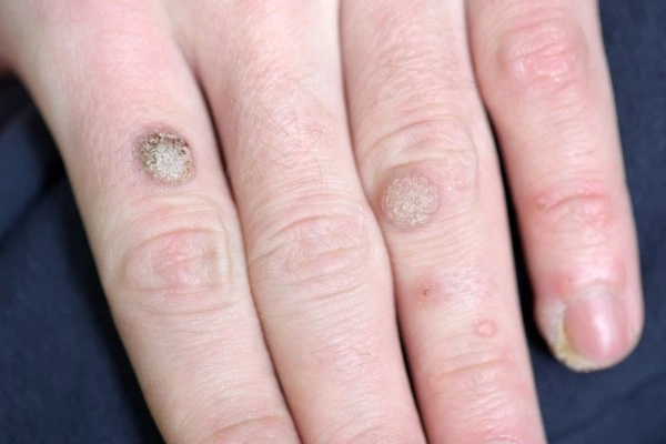 photo of warts on person hand - see wart removal Barnet from LA LIPO