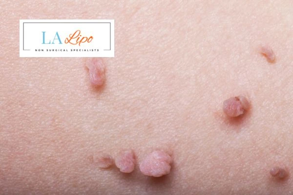 Does cryopen skin tag removal Barnet hurt? Find out now call our team today!