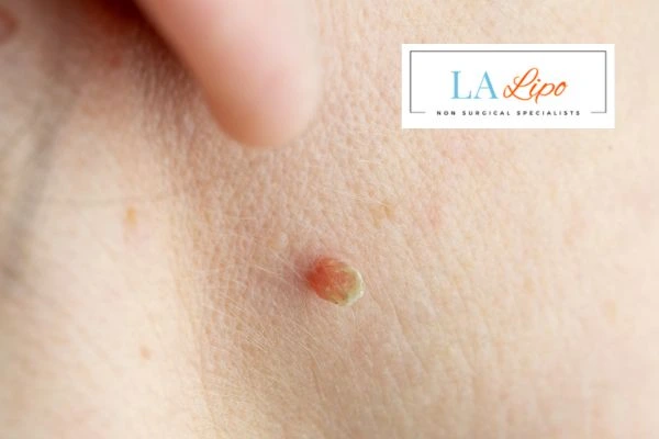 Book skin tag removal Barnet today speak to our team now!