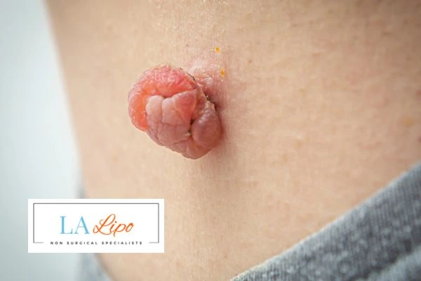 Interested in skin tag removal Barnet? Concerned about the pain? Find out more today!