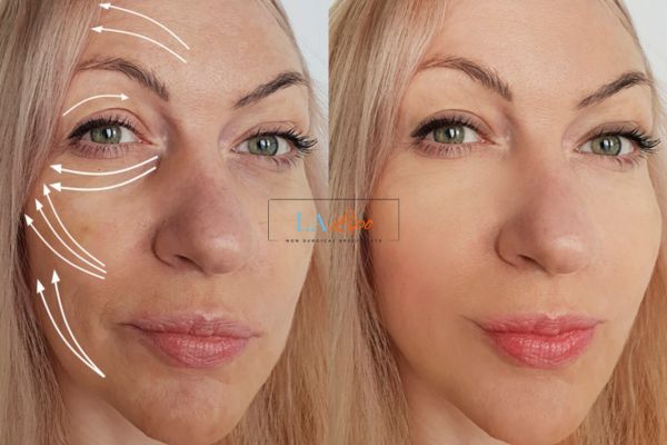 Morpheus 8 results Barnet face lift.