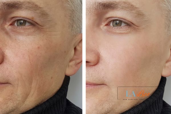 See the amazing results of Morpheus8 Treatment Barnet!