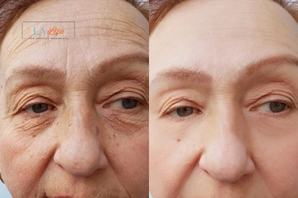 The powerful benefits of Morpheus8 Treatment Barnet - Call Our team today!