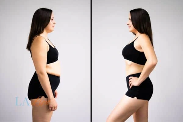 Picture of womans before and after using LA-EMS body sculpting to improve her core strength Barnet