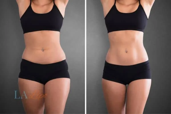 before and after results of non-surgical treatment to help a woman's body image and mental health Barnet