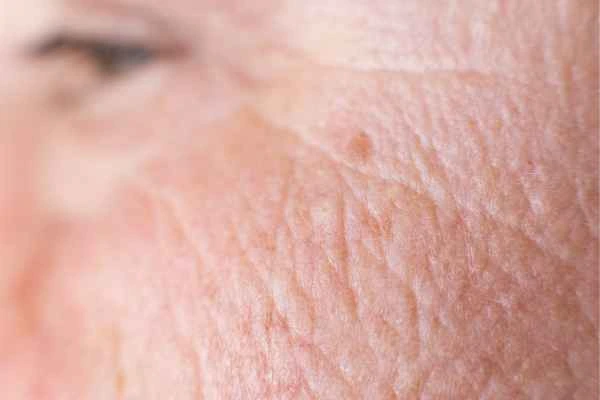 close up picture of a woman's face showing an age spot Barnet