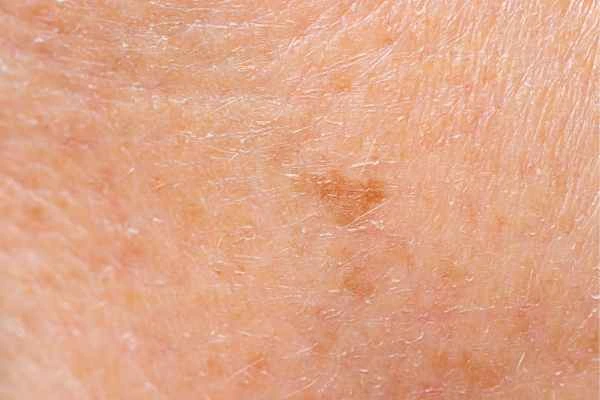 close up picture of age spots Barnet