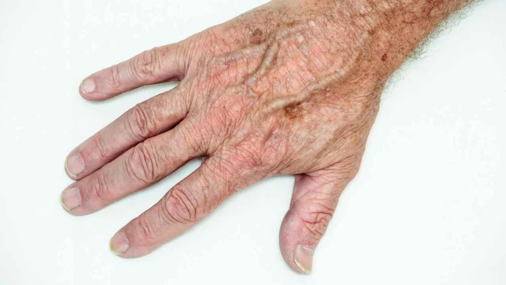 Male hand showing age spot Barnet