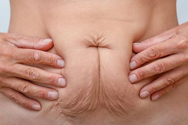 Image of a woman's stomach with loose skin - example of skin tightening Barnet options