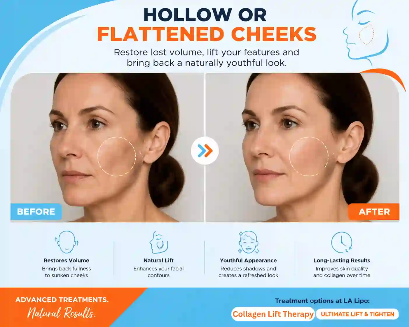 Sign #4: Hollow or Flattened Cheeks Barnet
