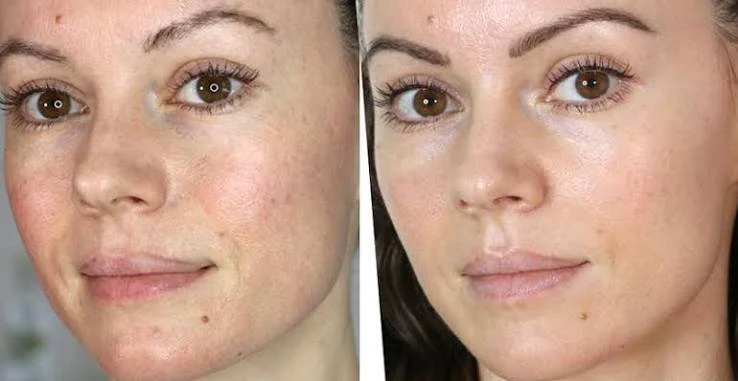 What happens during treatment Barnet